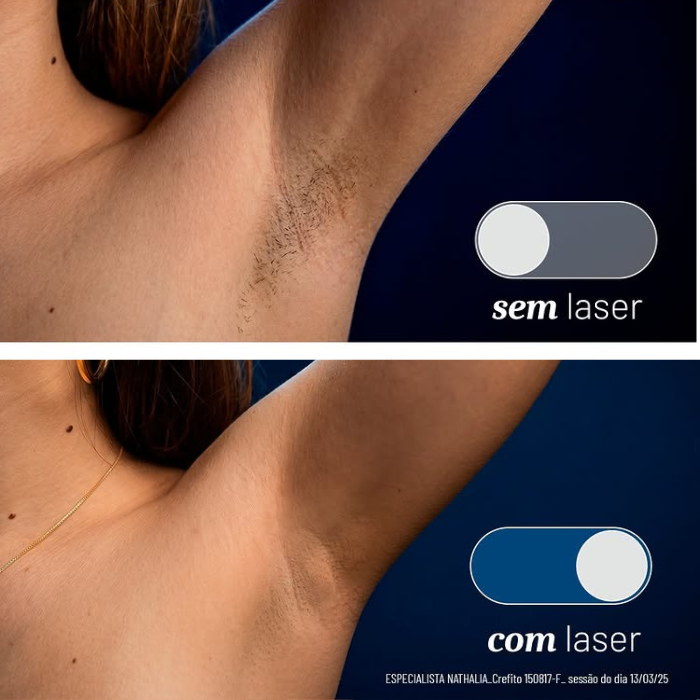 Comparativo: com laser x sem laser